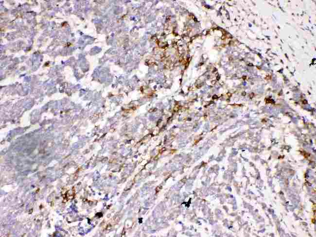 AQP3 / Aquaporin 3 Antibody - IHC analysis of Aquaporin 3 using anti-Aquaporin 3 antibody. Aquaporin 3 was detected in paraffin-embedded section of human lung cancer tissues. Heat mediated antigen retrieval was performed in citrate buffer (pH6, epitope retrieval solution) for 20 mins. The tissue section was blocked with 10% goat serum. The tissue section was then incubated with 1µg/ml rabbit anti-Aquaporin 3 Antibody overnight at 4°C. Biotinylated goat anti-rabbit IgG was used as secondary antibody and incubated for 30 minutes at 37°C. The tissue section was developed using Strepavidin-Biotin-Complex (SABC) with DAB as the chromogen.