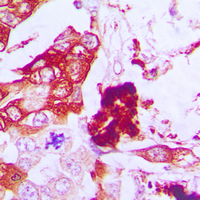 AQP3 / Aquaporin 3 Antibody - Immunohistochemical analysis of Aquaporin 3 staining in human lung cancer formalin fixed paraffin embedded tissue section. The section was pre-treated using heat mediated antigen retrieval with sodium citrate buffer (pH 6.0). The section was then incubated with the antibody at room temperature and detected using an HRP conjugated compact polymer system. DAB was used as the chromogen. The section was then counterstained with hematoxylin and mounted with DPX.