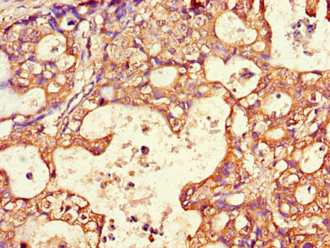 AQP3 / Aquaporin 3 Antibody - Immunohistochemistry of paraffin-embedded human gastric cancer using AQP3 Antibody at dilution of 1:100