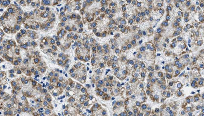 AQP3 / Aquaporin 3 Antibody - 1:100 staining human liver carcinoma tissues by IHC-P. The sample was formaldehyde fixed and a heat mediated antigen retrieval step in citrate buffer was performed. The sample was then blocked and incubated with the antibody for 1.5 hours at 22°C. An HRP conjugated goat anti-rabbit antibody was used as the secondary.