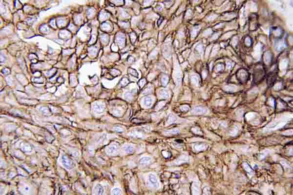 AQP3 / Aquaporin 3 Antibody - IHC of AQP3 (V214) pAb in paraffin-embedded human lung carcinoma tissue.