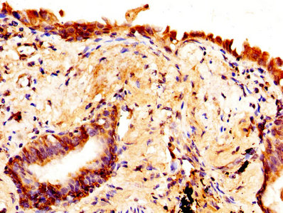 AQP4 / Aquaporin 4 Antibody - IHC image of AQP4 Antibody diluted at 1:370 and staining in paraffin-embedded human lung cancer performed on a Leica BondTM system. After dewaxing and hydration, antigen retrieval was mediated by high pressure in a citrate buffer (pH 6.0). Section was blocked with 10% normal goat serum 30min at RT. Then primary antibody (1% BSA) was incubated at 4°C overnight. The primary is detected by a biotinylated secondary antibody and visualized using an HRP conjugated SP system.