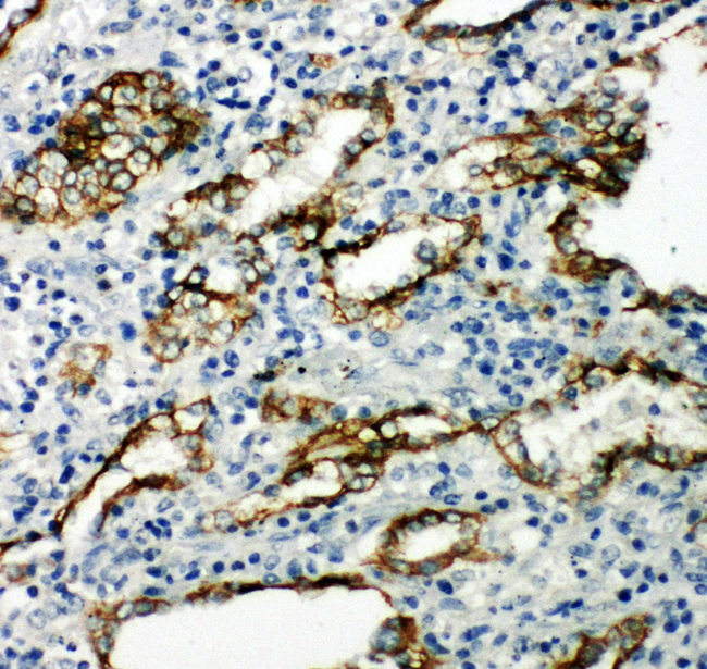 AQP4 / Aquaporin 4 Antibody - AQP4 / Aquaporin 4 antibody. IHC(P): Human Lung Cancer Tissue.