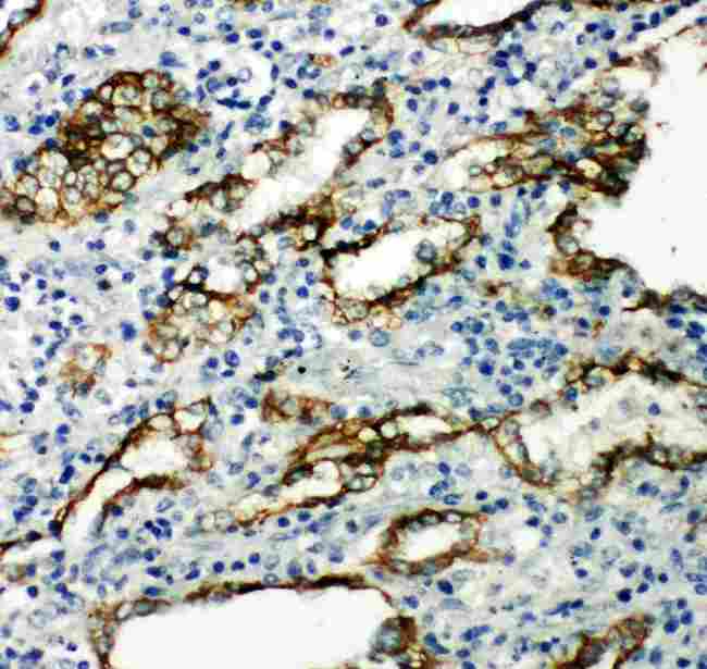 AQP4 / Aquaporin 4 Antibody - Anti-Aquaporin 4 antibody, IHC(P): Human Lung Cancer Tissue