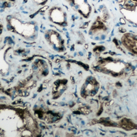 AQP4 / Aquaporin 4 Antibody - Immunohistochemical analysis of Aquaporin 4 staining in human lung cancer formalin fixed paraffin embedded tissue section. The section was pre-treated using heat mediated antigen retrieval with sodium citrate buffer (pH 6.0). The section was then incubated with the antibody at room temperature and detected using an HRP conjugated compact polymer system. DAB was used as the chromogen. The section was then counterstained with hematoxylin and mounted with DPX.