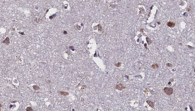 AQP4 / Aquaporin 4 Antibody - 1:100 staining human brain carcinoma tissue by IHC-P. The sample was formaldehyde fixed and a heat mediated antigen retrieval step in citrate buffer was performed. The sample was then blocked and incubated with the antibody for 1.5 hours at 22°C. An HRP conjugated goat anti-rabbit antibody was used as the secondary.