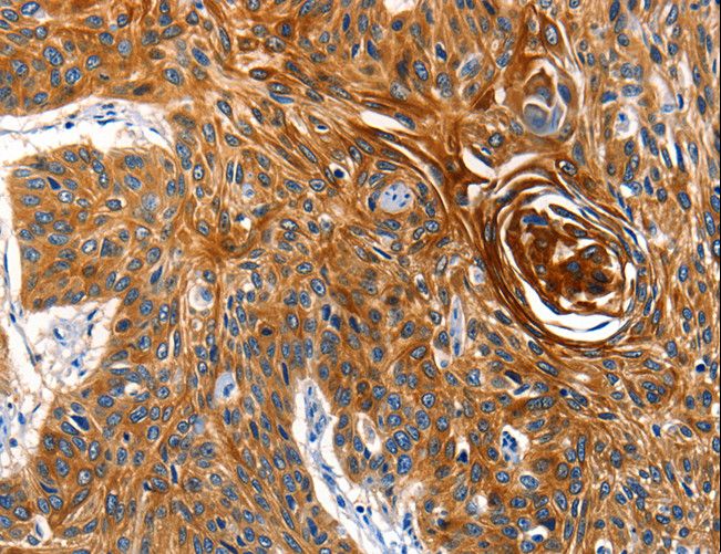 AQP5 / Aquaporin 5 Antibody - Immunohistochemistry of paraffin-embedded Human esophagus cancer using AQP5 Polyclonal Antibody at dilution of 1:40.