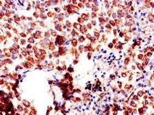 AQP6 / Aquaporin 6 Antibody - Immunohistochemistry of paraffin-embedded human lung cancer using AQP6 Antibody at dilution of 1:100