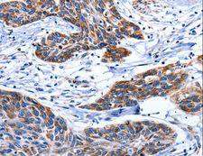 AQP8 / Aquaporin 8 Antibody - Immunohistochemistry of paraffin-embedded Human esophagus cancer using AQP8 Polyclonal Antibody at dilution of 1:75.