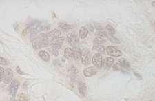 AQR Antibody - Detection of Human IBP160 by Immunohistochemistry. Sample: FFPE section of human ovarian carcinoma. Antibody: Affinity purified rabbit anti-IBP160 used at a dilution of 1:250.