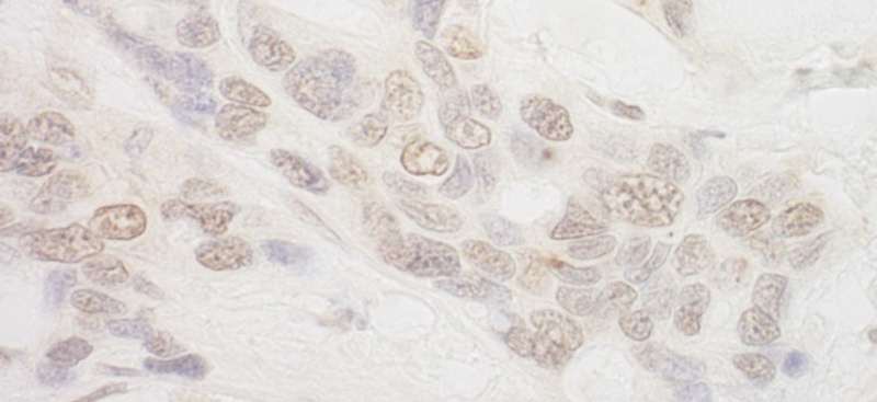 AQR Antibody - Detection of Human IBP160 by Immunohistochemistry. Sample: FFPE section of human ovarian carcinoma. Antibody: Affinity purified rabbit anti-IBP160 used at a dilution of 1:200 (1 ug/ml). Detection: DAB.