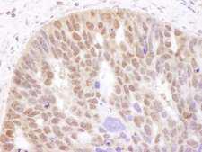 AR / Androgen Receptor Antibody - Detection of Human Androgen Receptor by Immunohistochemistry. Sample: FFPE section of human ovarian carcinoma. Antibody: Affinity purified rabbit anti-Androgen Receptor used at a dilution of 1:1000 (1 ug/ml). Detection: DAB.