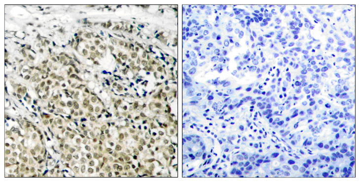 AR / Androgen Receptor Antibody - Immunohistochemistry analysis of paraffin-embedded human prostate carcinoma, using Androgen Receptor Antibody. The picture on the right is blocked with the synthesized peptide.