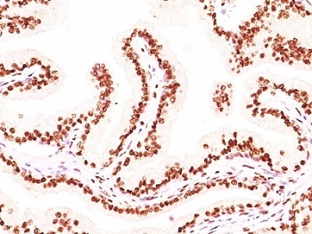 AR / Androgen Receptor Antibody - Formalin-fixed, paraffin-embedded human prostate carcinoma stained with Androgen Receptor antibody (AR441 + DHTR/882).  This image was taken for the unmodified form of this product. Other forms have not been tested.