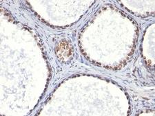 AR / Androgen Receptor Antibody - Formalin-fixed, paraffin-embedded human prostate carcinoma stained with AR antibody (AR441).  This image was taken for the unmodified form of this product. Other forms have not been tested.