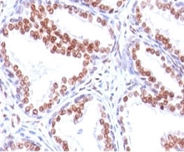 AR / Androgen Receptor Antibody - Formalin-fixed, paraffin-embedded human prostate carcinoma stained with anti-Androgen Receptor antibody (SPM335).  This image was taken for the unmodified form of this product. Other forms have not been tested.