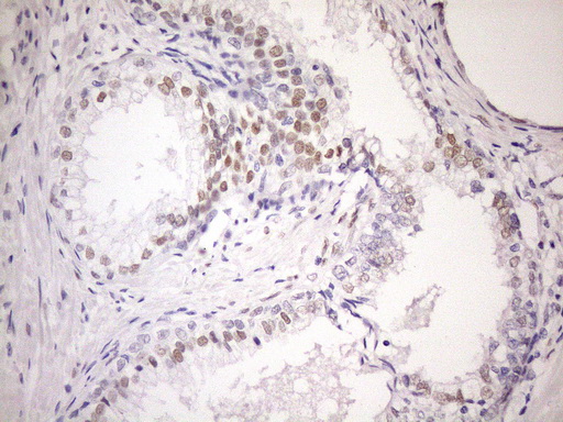 AR / Androgen Receptor Antibody - Immunohistochemical staining of paraffin-embedded Human prostate tissue within the normal limits using anti-AR mouse monoclonal antibody. (Heat-induced epitope retrieval by 1mM EDTA in 10mM Tris buffer. (pH8.5) at 120°C for 3 min. (1:150)