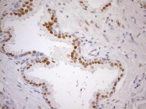 AR / Androgen Receptor Antibody - Immunohistochemical staining of paraffin-embedded Carcinoma of Human prostate tissue using anti-AR mouse monoclonal antibody. (Heat-induced epitope retrieval by 1mM EDTA in 10mM Tris buffer. (pH8.5) at 120°C for 3 min. (1:150)