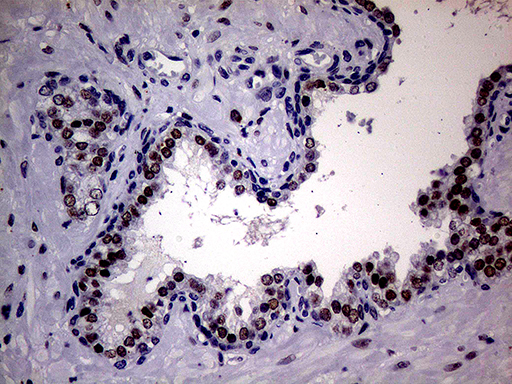 AR / Androgen Receptor Antibody - Immunohistochemical staining of paraffin-embedded Human prostate tissue within the normal limits using anti-AR mouse monoclonal antibody. (Heat-induced epitope retrieval by 1mM EDTA in 10mM Tris buffer. (pH8.5) at 120°C for 3 min. (1:1000)