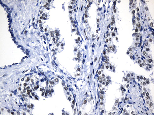 AR / Androgen Receptor Antibody - Immunohistochemical staining of paraffin-embedded Carcinoma of Human prostate tissue using anti-AR mouse monoclonal antibody. (Heat-induced epitope retrieval by 1mM EDTA in 10mM Tris buffer. (pH8.5) at 120°C for 3 min. (1:100)