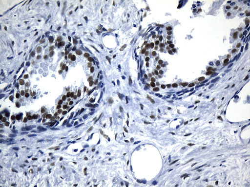 AR / Androgen Receptor Antibody - Immunohistochemical staining of paraffin-embedded Human prostate tissue within the normal limits using anti-AR mouse monoclonal antibody. (Heat-induced epitope retrieval by 1mM EDTA in 10mM Tris buffer. (pH8.5) at 120°C for 3 min. (1:100)