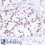 AR / Androgen Receptor Antibody - Immunohistochemistry of Human prostate adenocarcinoma stained with anti-AR (C-term) antibody