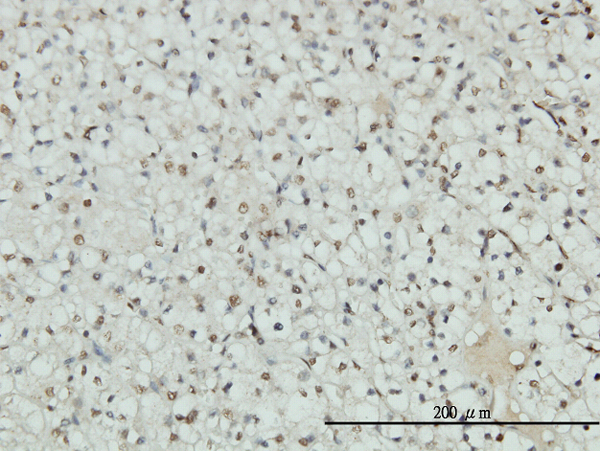 AR / Androgen Receptor Antibody - Immunoperoxidase of monoclonal antibody to AR on formalin-fixed paraffin-embedded human renal cell carcinoma tissue. [antibody concentration 3 ug/ml].