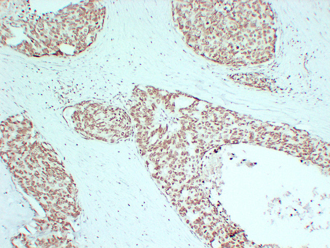AR / Androgen Receptor Antibody - Prostatic Carcinoma