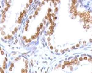 AR / Androgen Receptor Antibody - IHC testing of FFPE human prostate carcinoma and Androgen Receptor antibody (clone ANDRC-1).  This image was taken for the unmodified form of this product. Other forms have not been tested.