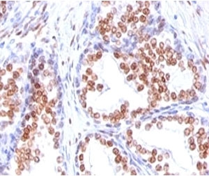 AR / Androgen Receptor Antibody - Formalin-fixed, paraffin-embedded human prostate carcinoma stained with Androgen Receptor antibody (DHTR/882).  This image was taken for the unmodified form of this product. Other forms have not been tested.