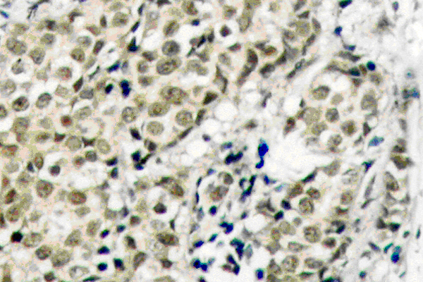 AR / Androgen Receptor Antibody - IHC of Androgen Receptor (G207) pAb in paraffin-embedded human prostate carcinoma tissue.