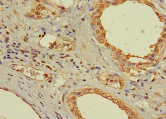 AR / Androgen Receptor Antibody - Immunohistochemistry of paraffin-embedded human prostate cancer at dilution 1:100