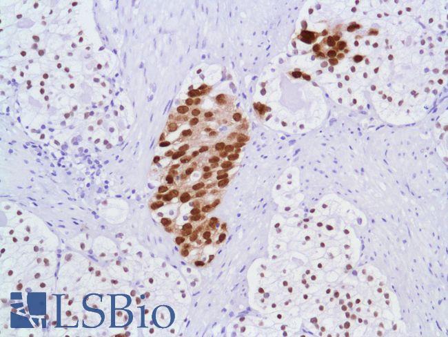 AR / Androgen Receptor Antibody - Immunohistochemistry of Human Prostate Adenocarcinoma stained with anti-Androgen Receptor (AR) antibody