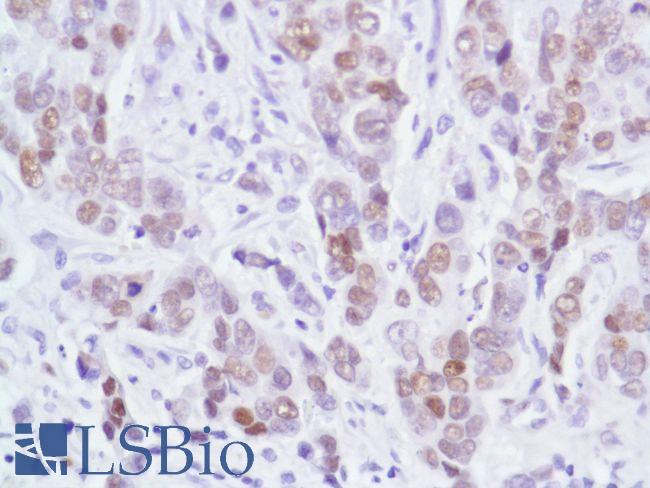 AR / Androgen Receptor Antibody - Immunohistochemistry of Human Breast Ductal Carcinoma stained with anti-Androgen Receptor (AR) antibody