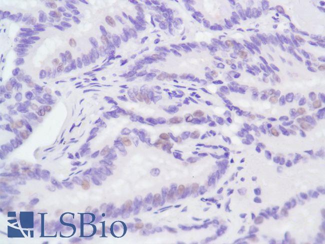 AR / Androgen Receptor Antibody - Immunohistochemistry of Human Lung Adenocarcinoma stained with anti-Androgen Receptor (AR) antibody