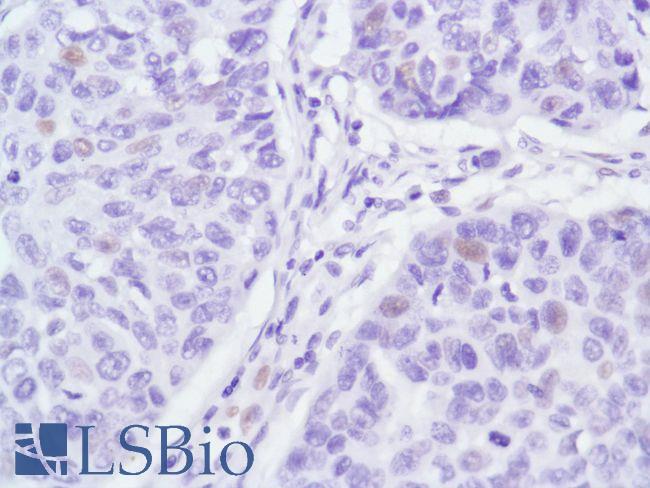 AR / Androgen Receptor Antibody - Immunohistochemistry of Human Lung Squamous Cell Carcinoma stained with anti-Androgen Receptor (AR) antibody