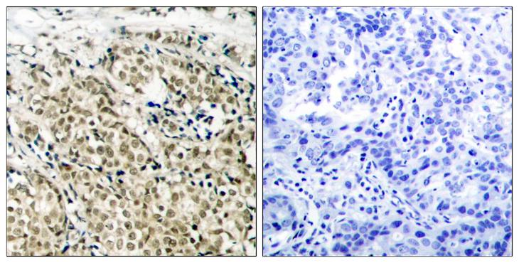 AR / Androgen Receptor Antibody - Peptide - + Immunohistochemical analysis of paraffin-embedded human prostate carcinoma tissue using Androgen Receptor (Ab-213) antibody.