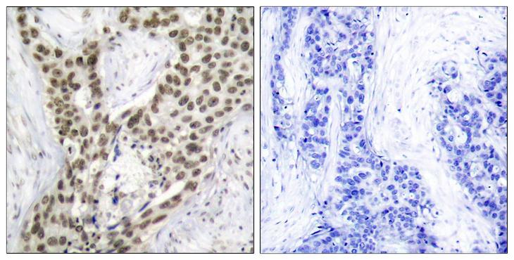 AR / Androgen Receptor Antibody - Immunohistochemistry analysis of paraffin-embedded human prostate carcinoma, using Androgen Receptor (Phospho-Ser213) Antibody. The picture on the right is blocked with the phospho peptide.