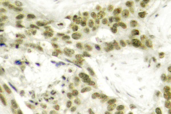 AR / Androgen Receptor Antibody - IHC of p-Androgen Receptor (S213) pAb in paraffin-embedded human prostate carcinoma tissue.