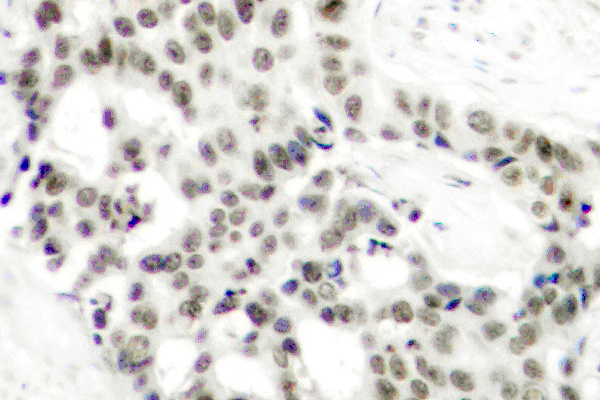 AR / Androgen Receptor Antibody - IHC of p-Androgen Receptor (S650) pAb in paraffin-embedded human breast carcinoma tissue.