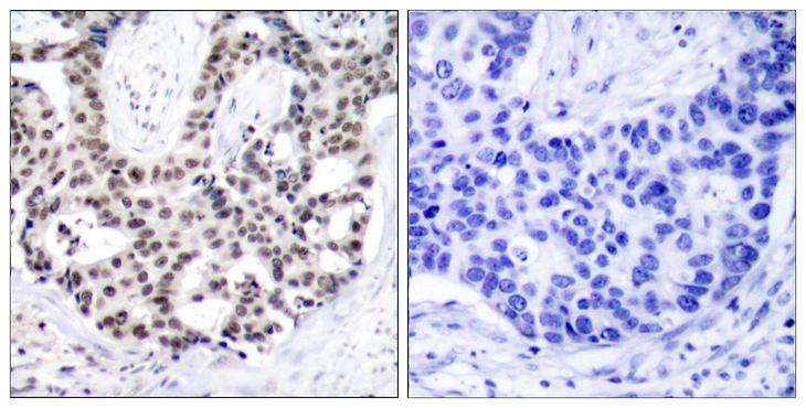 AR / Androgen Receptor Antibody - P-peptide - + Immunohistochemical analysis of paraffin-embedded human prostate carcinoma tissue using Androgen Receptor (phospho-Ser650) antibody.