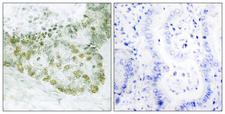 ARA55 / HIC-5 Antibody - Immunohistochemistry analysis of paraffin-embedded human lung carcinoma tissue, using Hic-5 Antibody. The picture on the right is blocked with the synthesized peptide.
