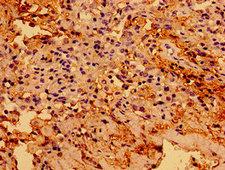 ARA55 / HIC-5 Antibody - Immunohistochemistry image of paraffin-embedded human cervical cancer at a dilution of 1:100