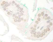 ARA70 / NCOA4 Antibody - Detection of Human ARA70 by Immunohistochemistry. Sample: FFPE section of human prostate carcinoma. Antibody: Affinity purified rabbit anti-ARA70 used at a dilution of 1:250.