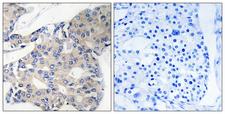 ARA70 / NCOA4 Antibody - Immunohistochemistry of paraffin-embedded human breast carcinoma tissue, using NCOA4 antibody.
