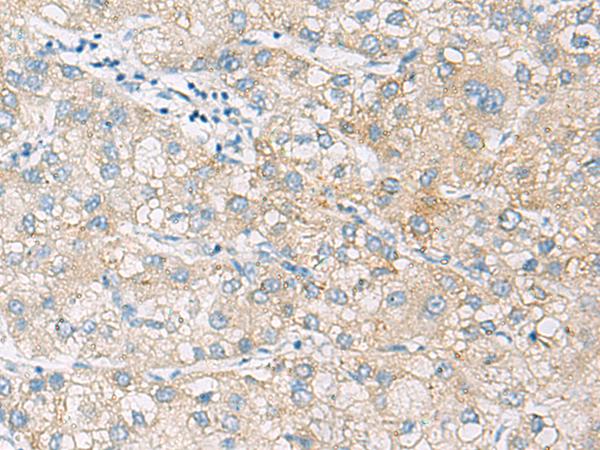 ARA70 / NCOA4 Antibody - Immunohistochemistry of paraffin-embedded Human liver cancer tissue  using NCOA4 Polyclonal Antibody at dilution of 1:130(×200)