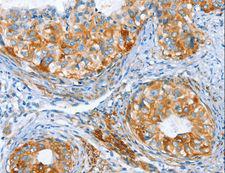 ARA9 / AIP Antibody - Immunohistochemistry of paraffin-embedded Human thyroid cancer using AIP Polyclonal Antibody at dilution of 1:80.