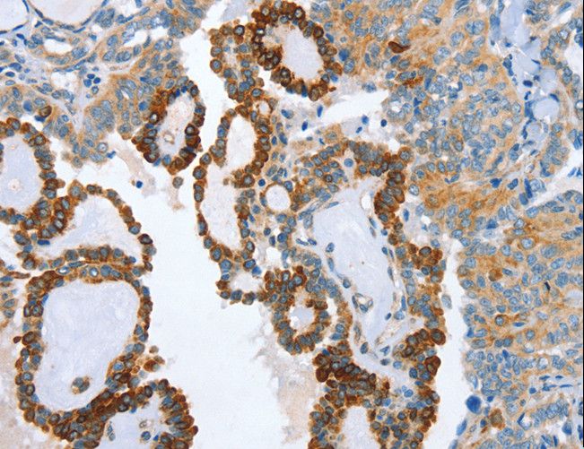 ARA9 / AIP Antibody - Immunohistochemistry of paraffin-embedded Human thyroid cancer using AIP Polyclonal Antibody at dilution of 1:80.