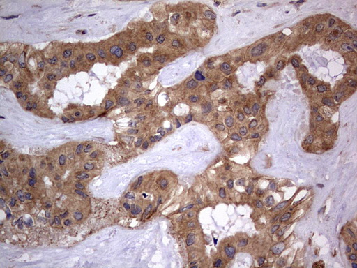 ARAF / ARAF1 / A-RAF Antibody - IHC of paraffin-embedded Carcinoma of Human liver tissue using anti-ARAF mouse monoclonal antibody. (Heat-induced epitope retrieval by 1 mM EDTA in 10mM Tris, pH8.5, 120°C for 3min).