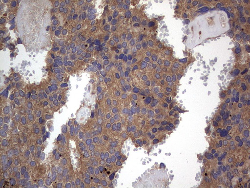 ARAF / ARAF1 / A-RAF Antibody - IHC of paraffin-embedded Adenocarcinoma of Human breast tissue using anti-ARAF mouse monoclonal antibody. (Heat-induced epitope retrieval by 1 mM EDTA in 10mM Tris, pH8.5, 120°C for 3min).